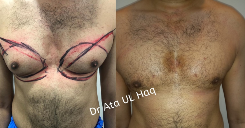 Gynecomastia in Lahore | Male Breast Reduction Procedure